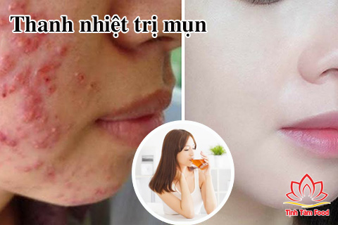 Công dụng trị mụn Cao Atiso