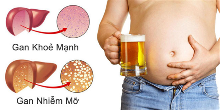 gan nhiễm mỡ do uống bia rượu